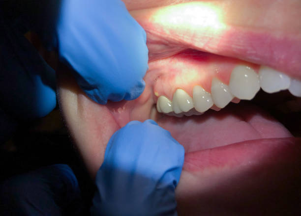 Best Dental Abscess Treatment in Vian, OK